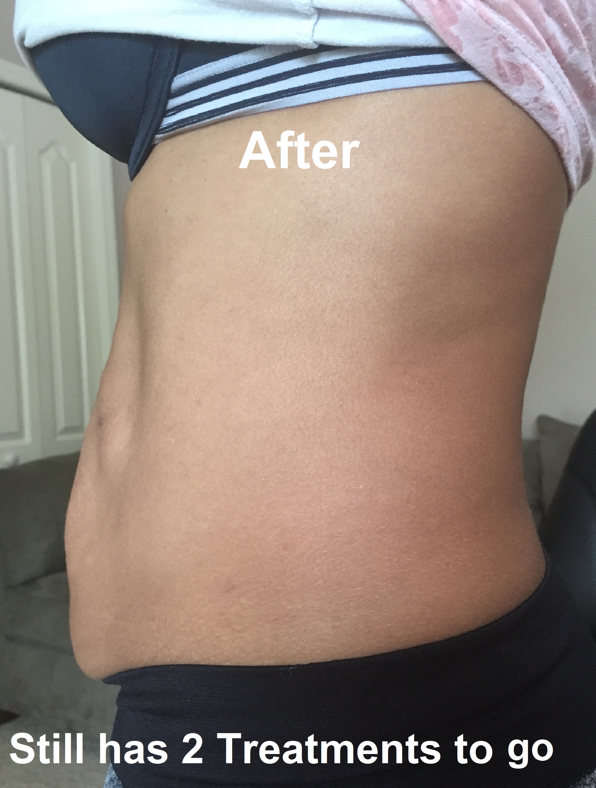 Before and After Photos - VIP Health and Laser Clinic Gainesville, FL