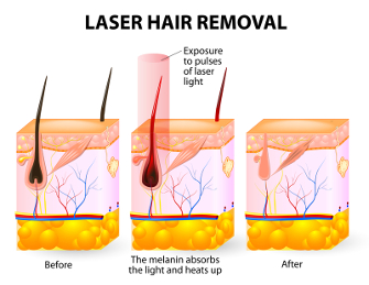 Laser Hair Removal FAQ - Get Answers Now -VIP Health and Laser Clinic