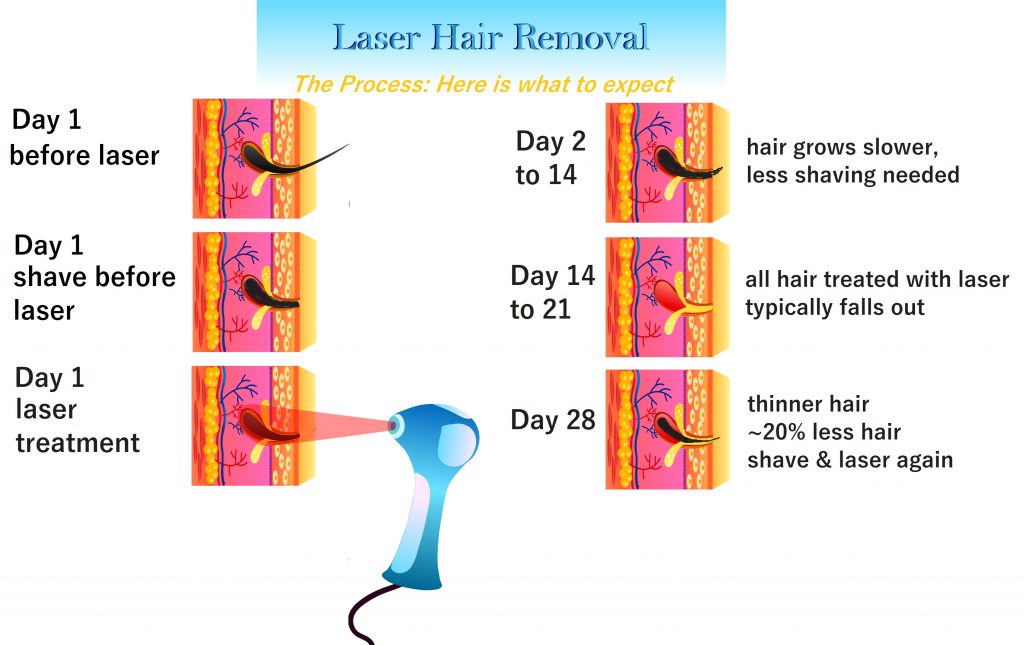 Laser Hair Removal FAQ - Get Answers Now -VIP Health and Laser Clinic