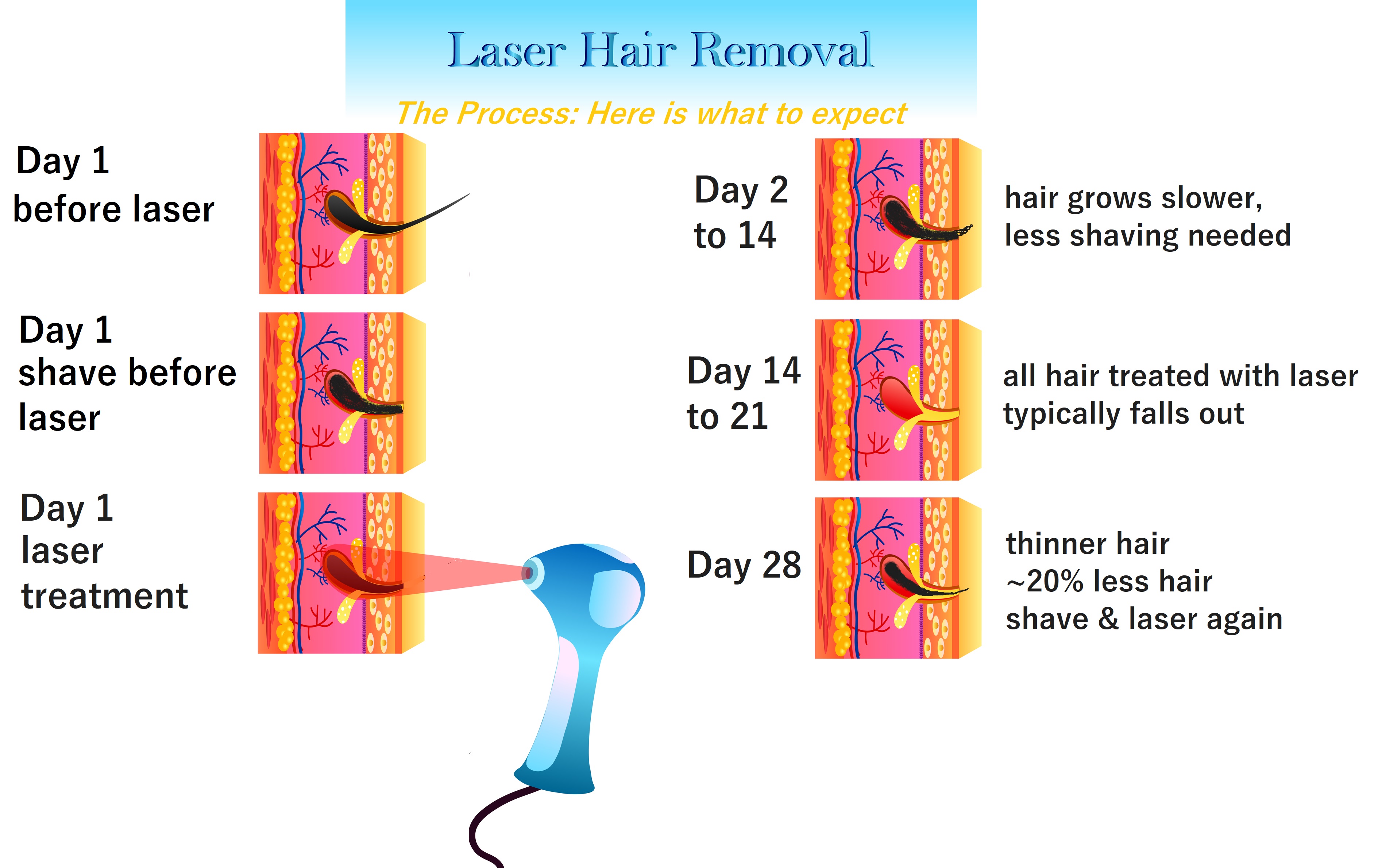laser treatment course and what to expect