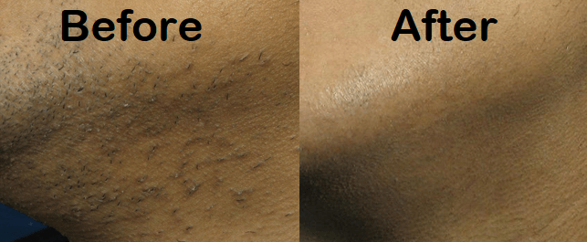 shaving-bumps-before-after-laser