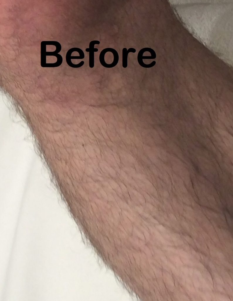 before-laser-leg-hair