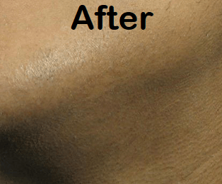 ingrown hairs after laser