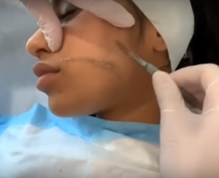 Dermaplaning Facial at VIP Health and Laser Gainesville FL