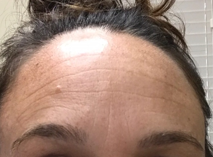 Before-Botox-Forehead-Wrinkles