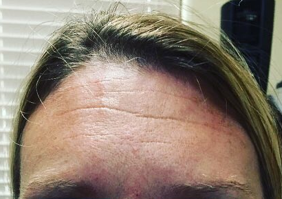Before-Botox-Forehead-Wrinkles-2