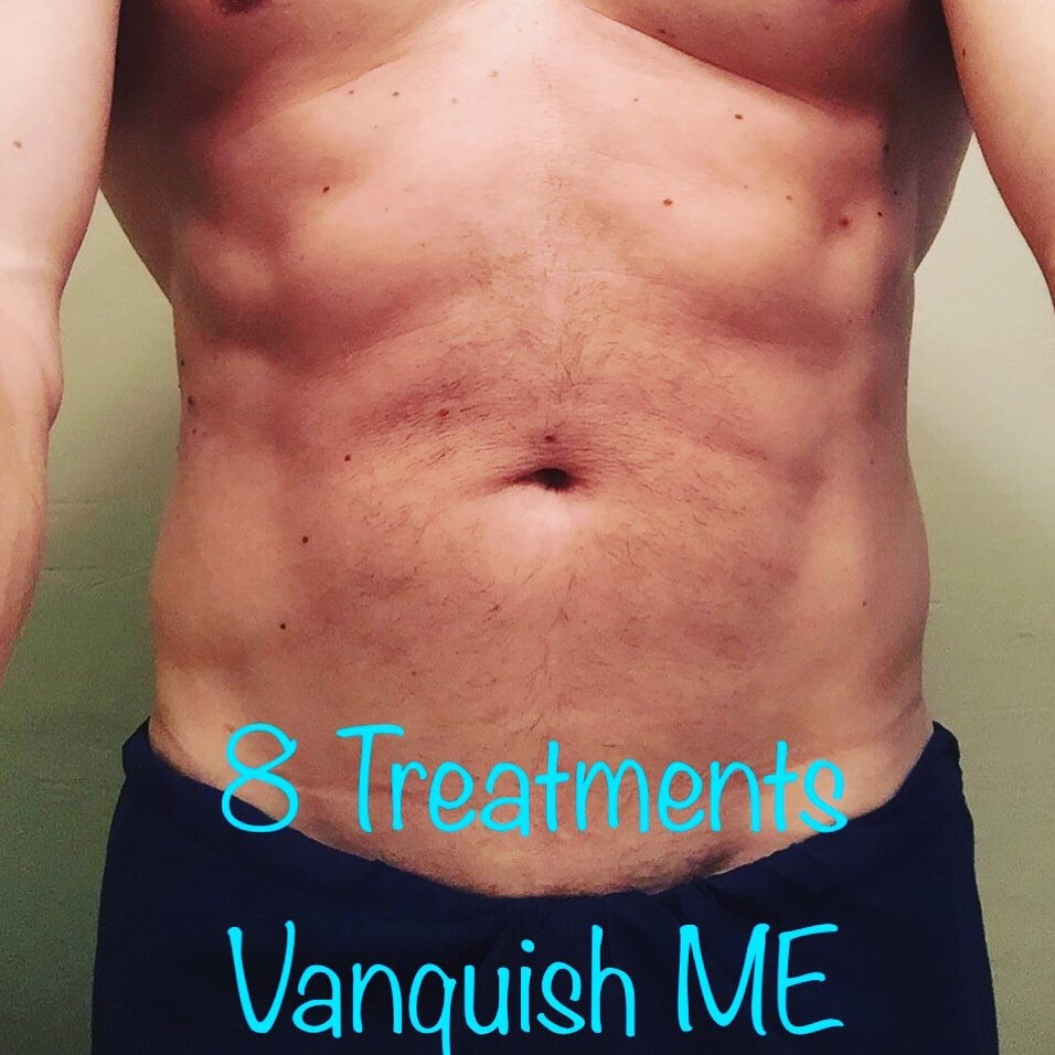 Vanquish-ME-Gainesville-FL-8-Treatments