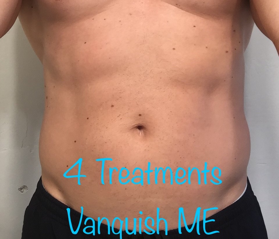 Vanquish-ME-4-treatments-Gainesville-FL