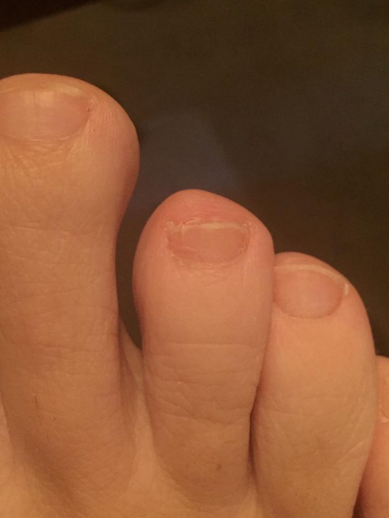 After Laser for Toenail Fungus