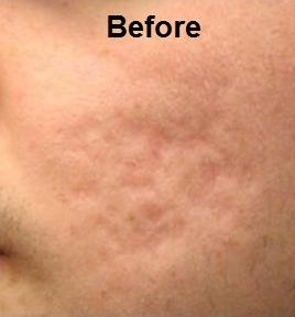Before Micro Needling Acne Scars with SkinPen Precision
