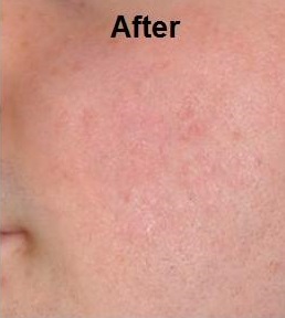 After Micro Needling with SkinPen Precision