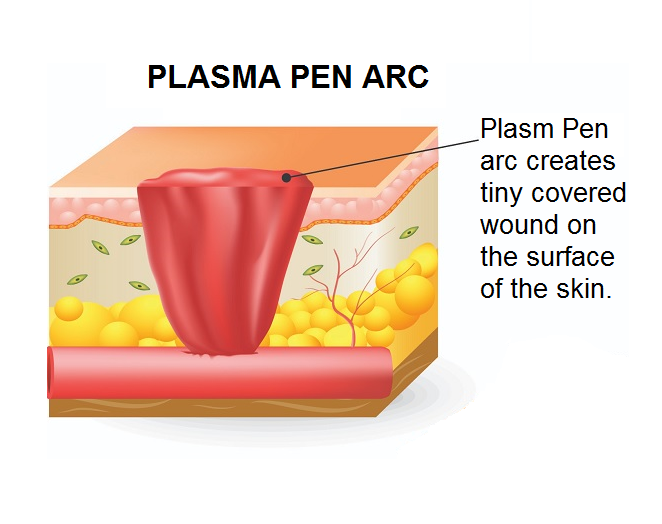 plasma-pen-arc