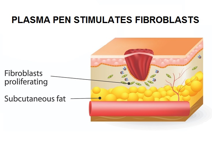 Plasma Pen Stimulates Fibroblasts